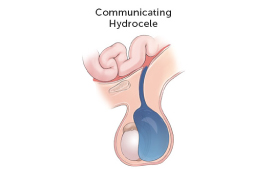 Communicating hydrocele