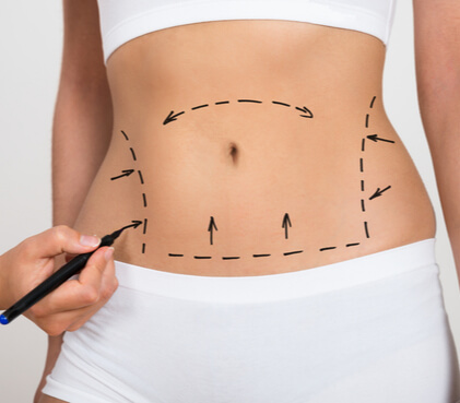 Tummy Tuck Surgery Cost in Chandigarh - Low Cost Estimate