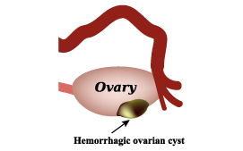 Hemorrhagic ovarian cyst
