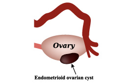 Endometriomas