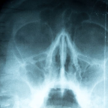 nasal septum radiograph
