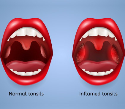 tonsillitis formation