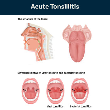 Acute tonsilitis