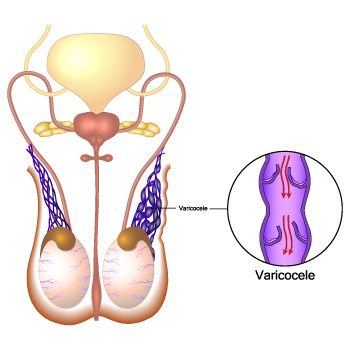 Lesser known facts about Varicocele