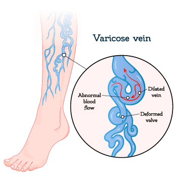 Facts about varicose veins