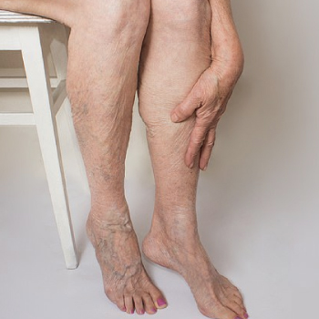 Celebrities diagnosed with varicose veins