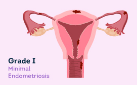 Grade I Endometriosis 