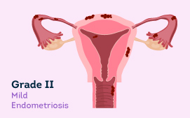 Grade II Endometriosis 