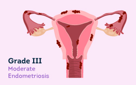 Grade III Endometriosis 