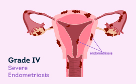 Grade IV Endometriosis 