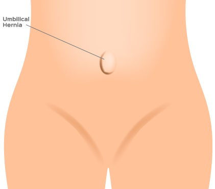 what-is-umbilical-hernia
