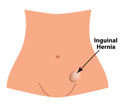 what-is-inguinal-hernia