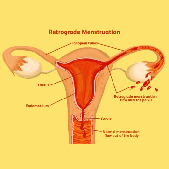 Retrograde Endometriosis