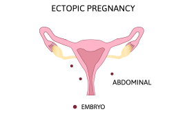 Abdominal Ectopic Pregnancy 