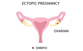 Ovarian Ectopic Pregnancy 