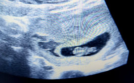 Partial Mole Ectopic Pregnancy 
