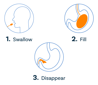 know-more-about-Gastric Balloon-treatment-in-Dhaka