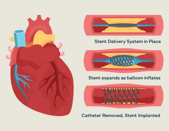 know-more-about-Angioplasty-treatment-in-