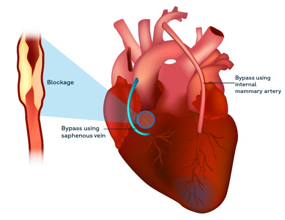 know-more-about-CABG-treatment-in-