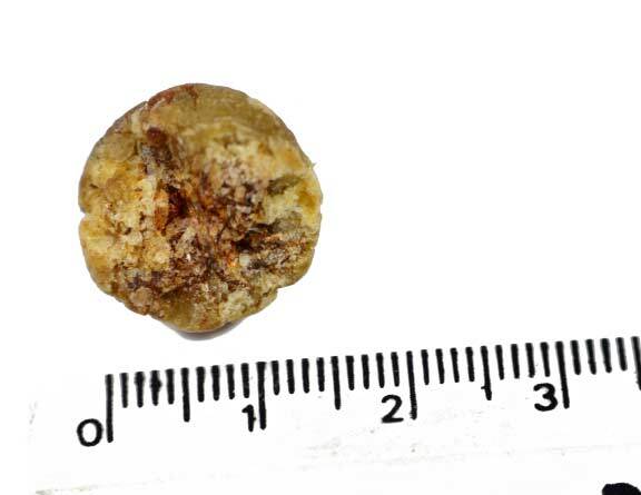 8 mm Kidney Stone Image