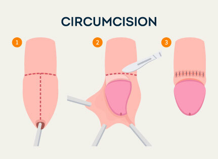 know-more-about-Laser Circumcision-treatment-in-Belgaum