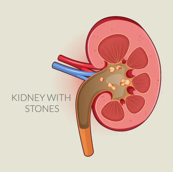 Doctor performing kidney stone surgery