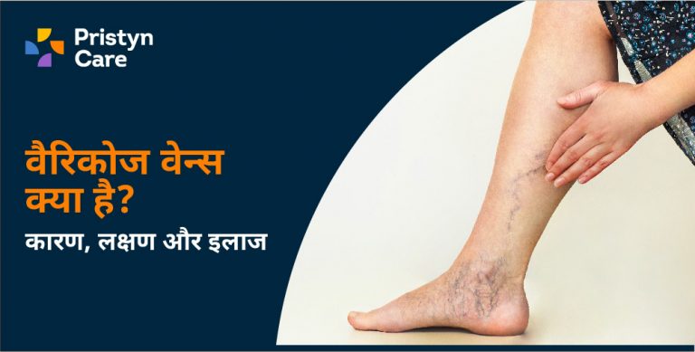 वैरिकोज वेन्स क्या है varicose veins in hindi