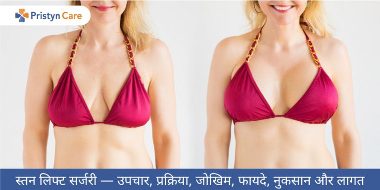 breast-lift-surgery-in-hindi