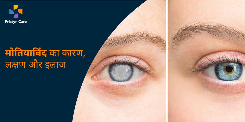 cataract-in-hindi-pristyn-care