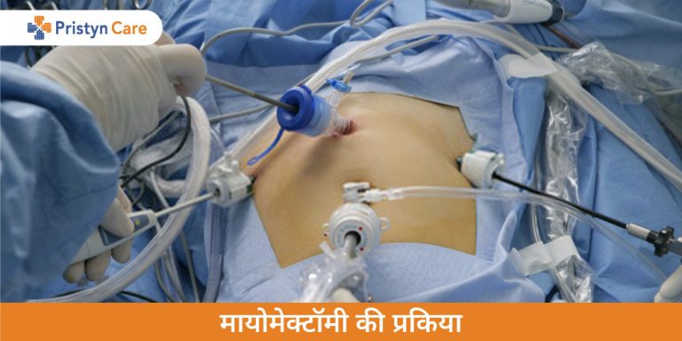 Myomectomy in Hindi