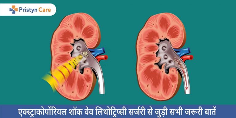 extracorporeal-shock-wave-lithotripsy-in-hindi