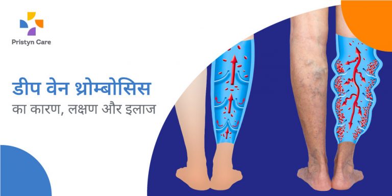 deep-vein-thrombosis-in-hindi