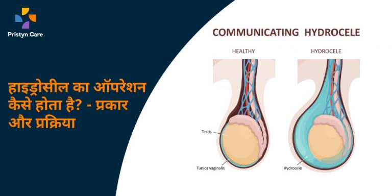 हाइड्रोसील की सर्जरी कैसे होती है