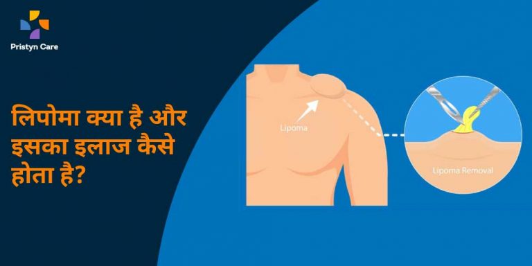 lipoma-in-hindi