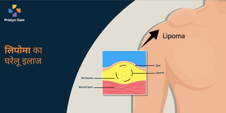 lipoma-home-treatment-in-hindi